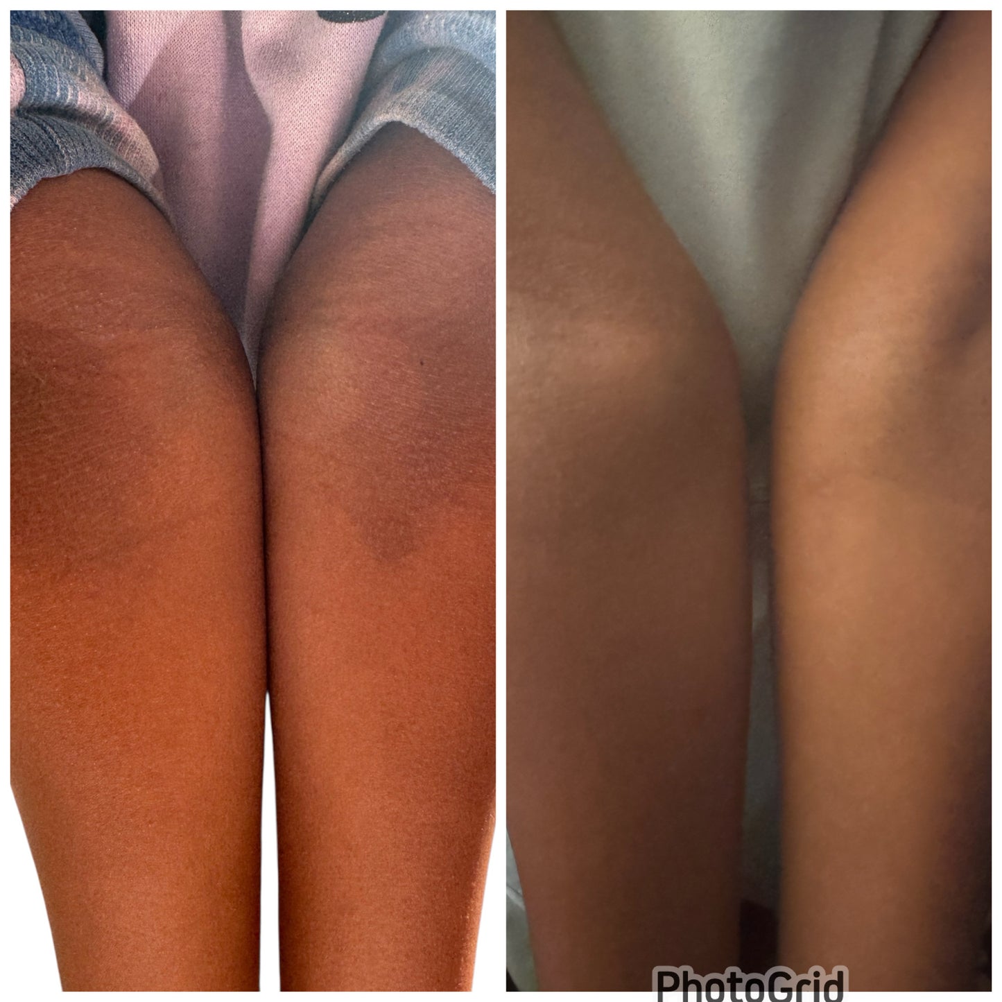 Manuka Honey Eczema Cream  With Organic Colloidal Oatmeal  For Eczema,Psoriasis,Diaper Rash,& More  Handmade All Natural & Organic Ingredients  Fragrance Free   4oz   (Handcrafted just for you)